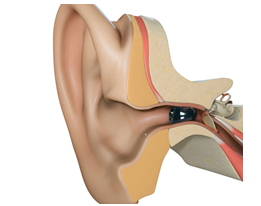 玫系列助聽(tīng)器（定制式）